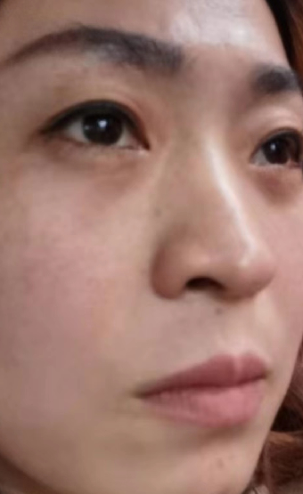 去眼袋手术