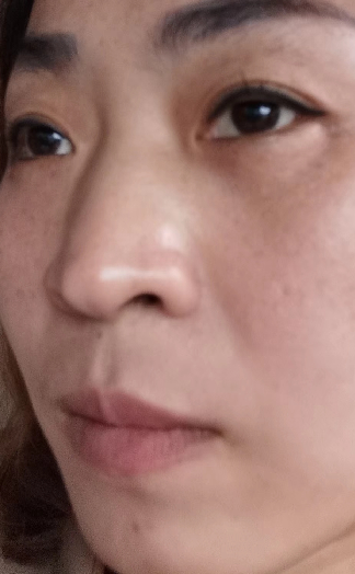 去眼袋手术