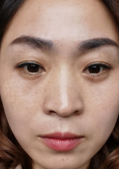 去眼袋手术