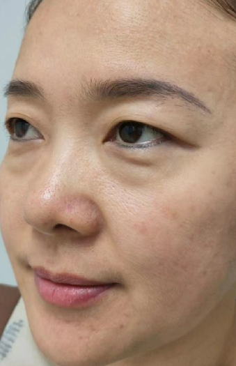 去眼袋手术