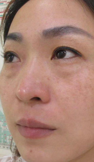 去眼袋手术