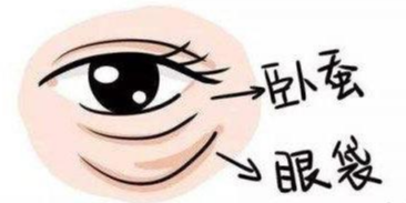 去眼袋手术