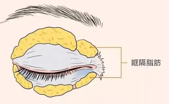 去眼袋手术
