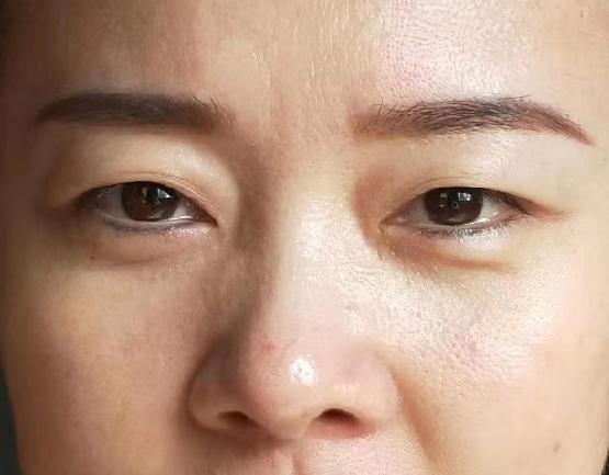去眼袋手术