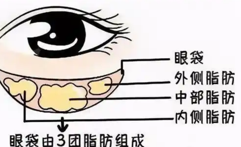 去眼袋手术