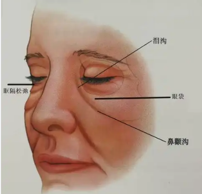 眼袋