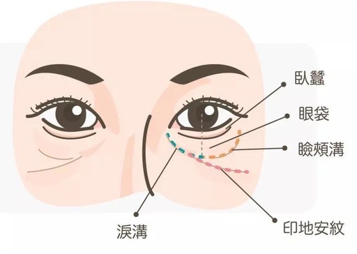 眼袋