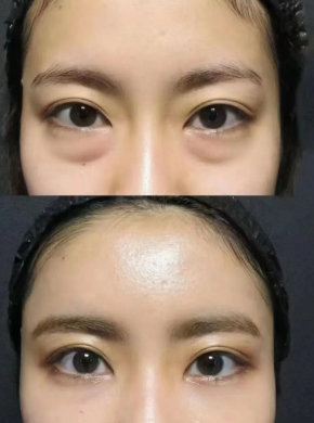 眼袋