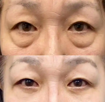 眼袋