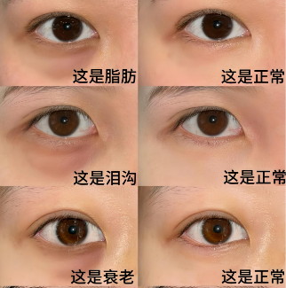 眼袋