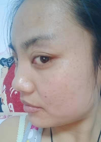 眼袋
