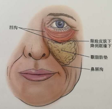眼袋