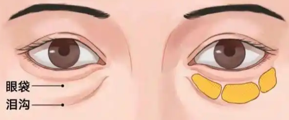 眼袋