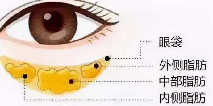 眼袋