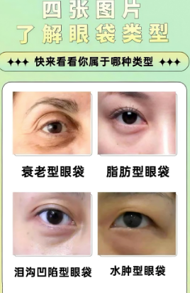 去眼袋手术