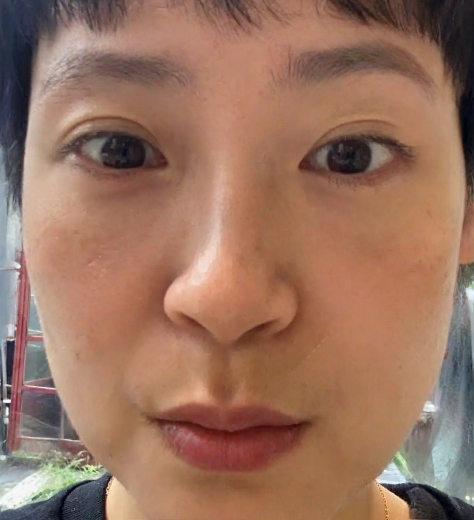 去眼袋手术