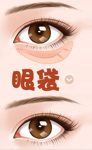 去眼袋手术