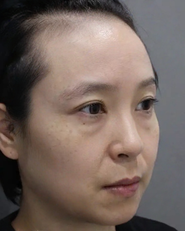 去眼袋手术