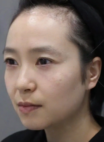 去眼袋手术