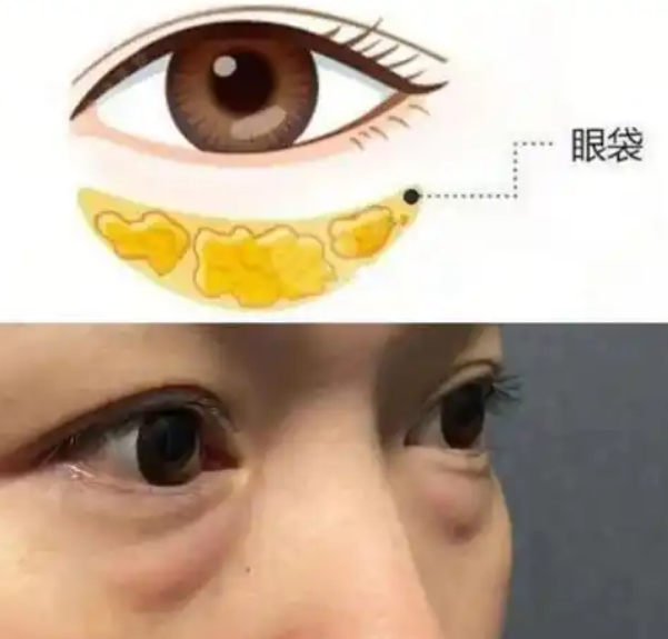 去眼袋手术