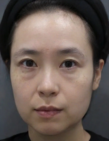 去眼袋手术
