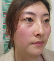 眼袋