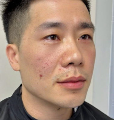 去眼袋手术
