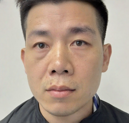 去眼袋手术