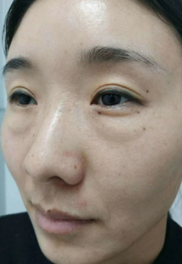 去眼袋手术