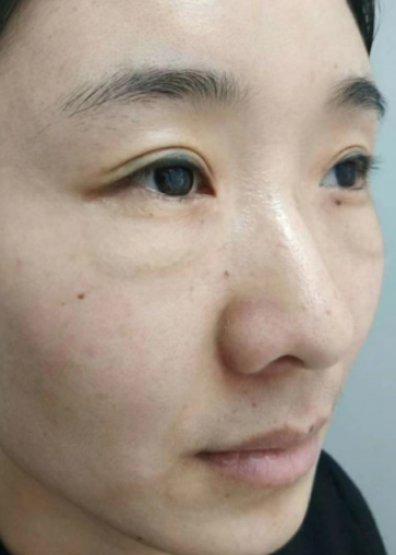 去眼袋手术
