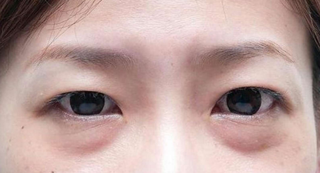 去眼袋手术