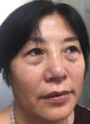 去眼袋手术