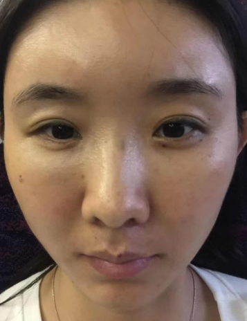 去眼袋手术
