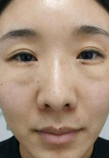去眼袋手术