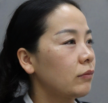 去眼袋手术