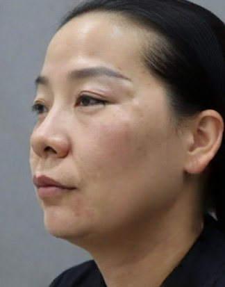 去眼袋手术