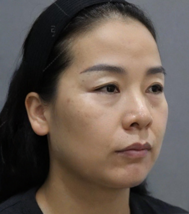 去眼袋手术