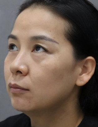 去眼袋手术