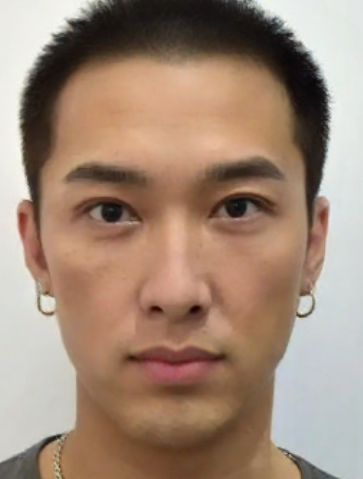 去眼袋手术