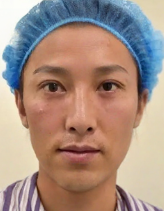 去眼袋手术