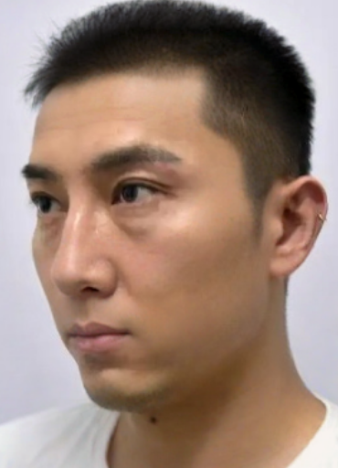 去眼袋手术