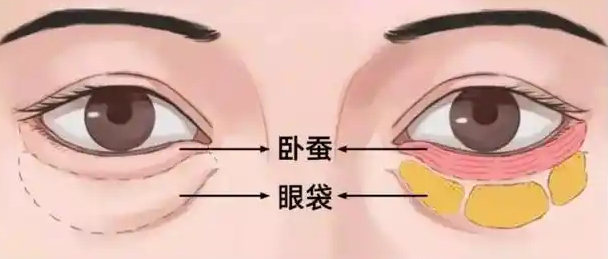眼袋