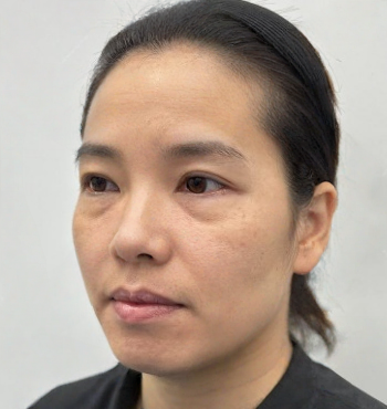 去眼袋手术