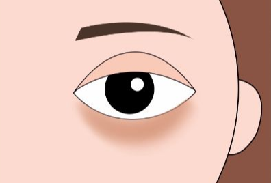 去眼袋手术