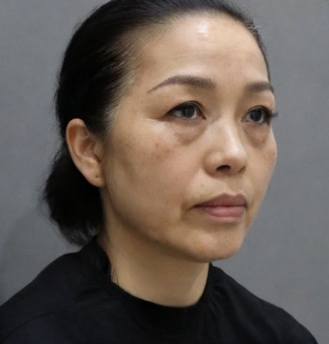 去眼袋手术