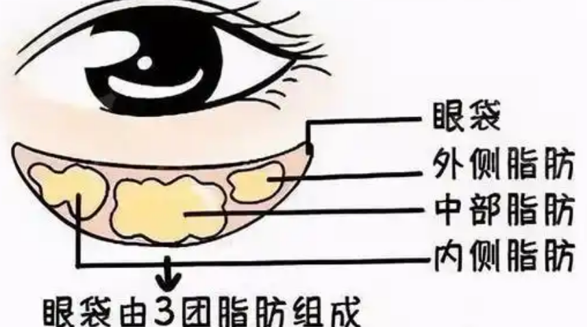 去眼袋手术