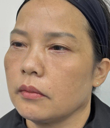去眼袋手术
