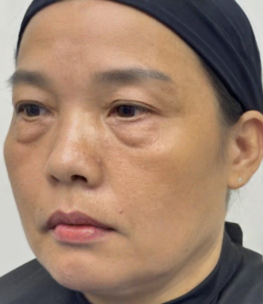 去眼袋手术