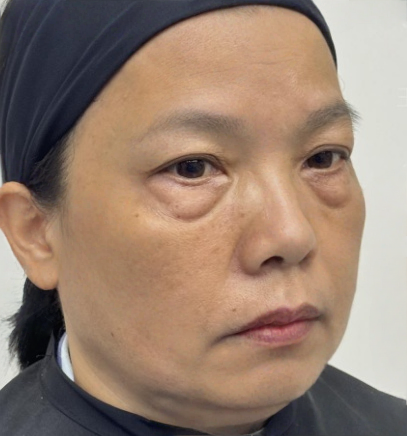 去眼袋手术