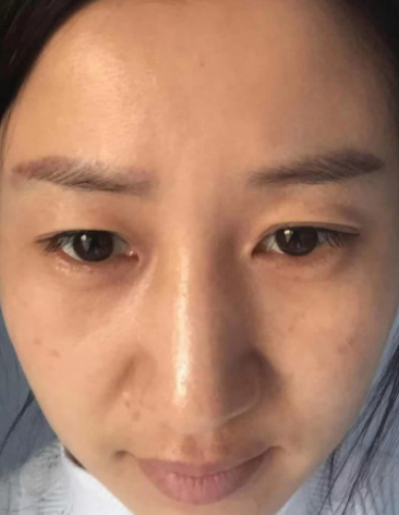 去眼袋手术